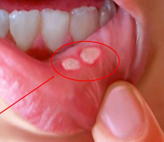 मुख, ओठ र जिब्रोका खटिरा सजिलै हटाउन अपनाउनुस् यस्तो घरेलु उपचार